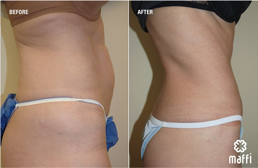 Before After Img
