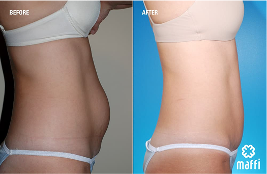 Before After Img