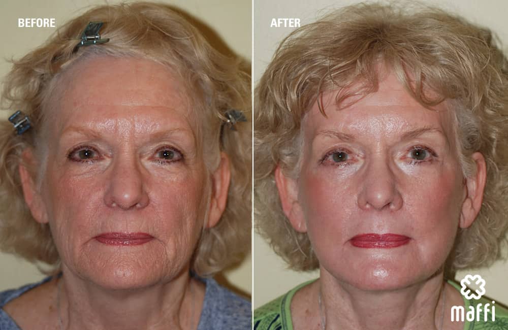 Before After Img