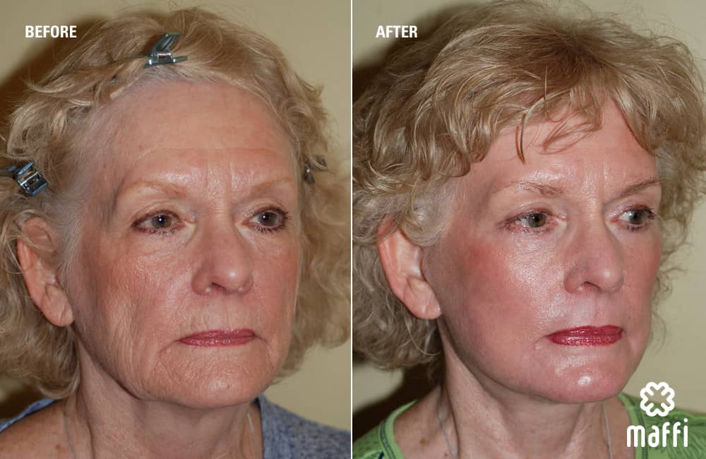 Before After Img