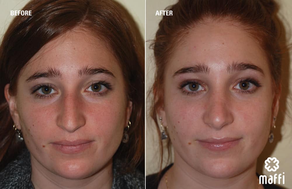 Before After Img