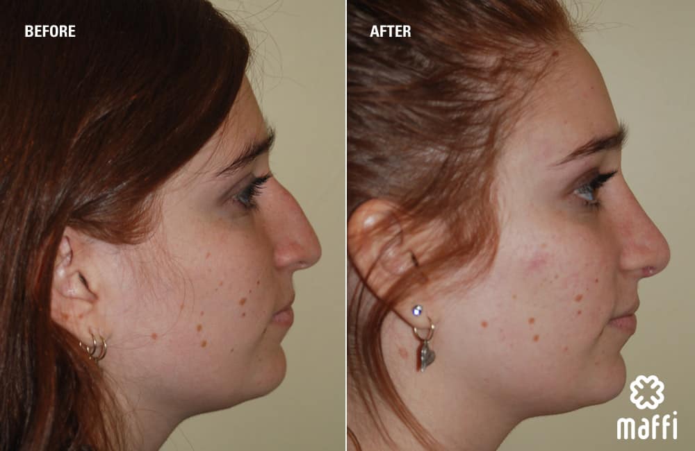 Before After Img