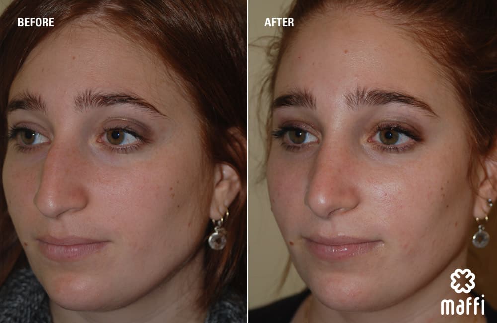 Before After Img