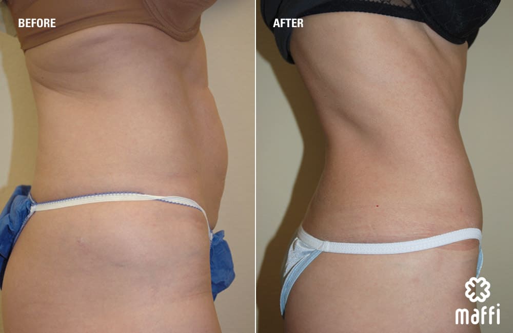 Before After Img