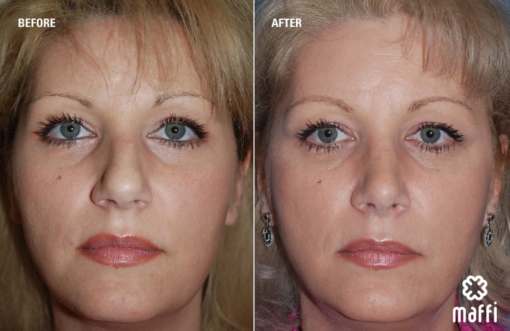 Before After Img