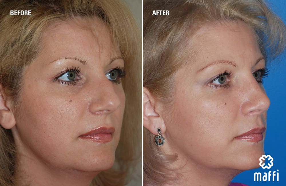 Before After Img
