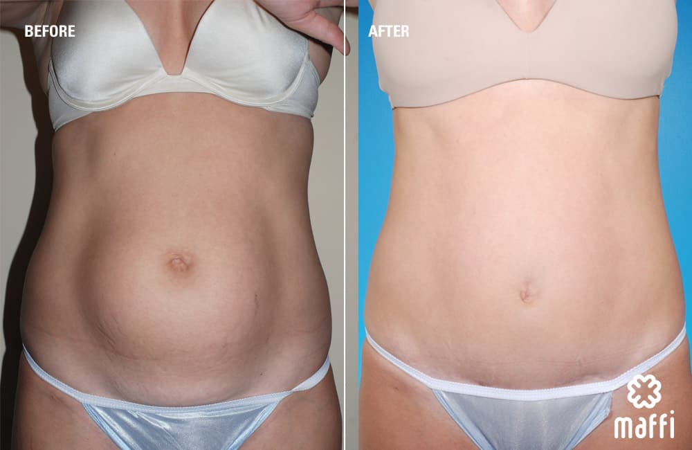 Before After Img
