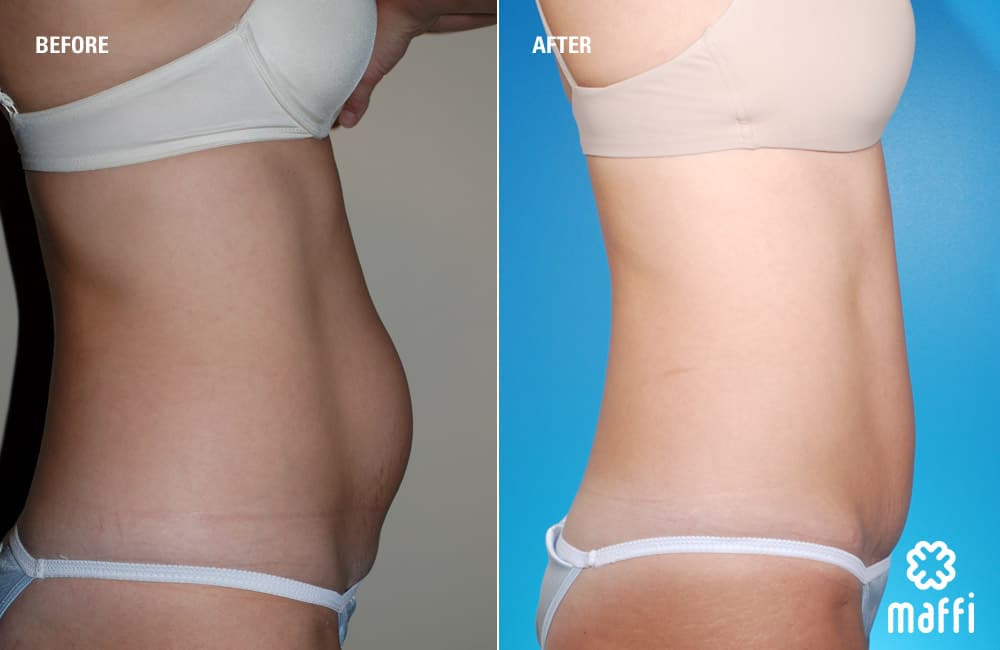 Before After Img