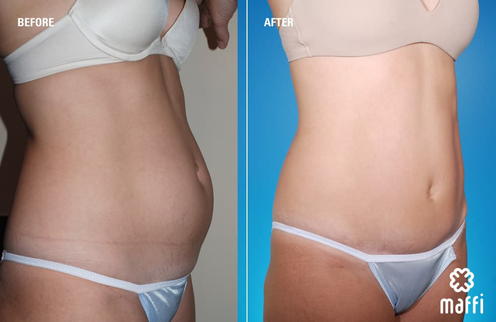 Before After Img