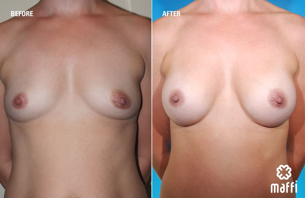 Before After Img