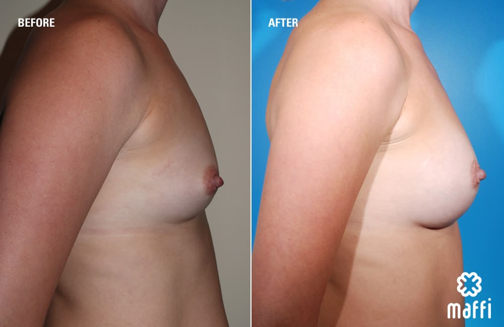 Before After Img