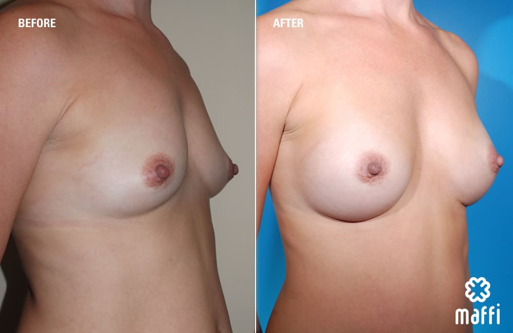 Before After Img