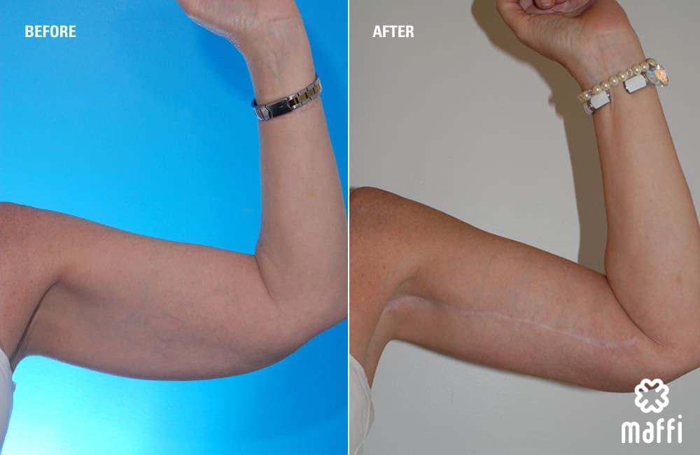 Before After Img