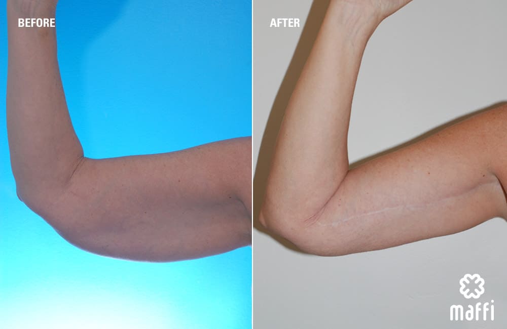 Before After Img