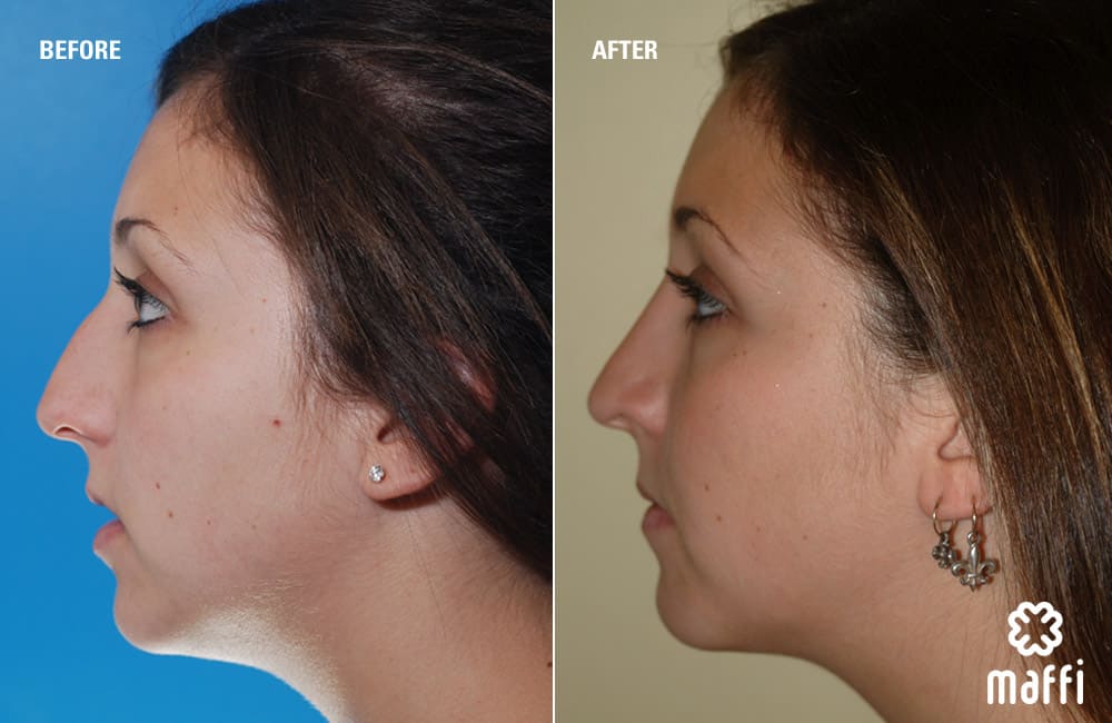 Before After Img