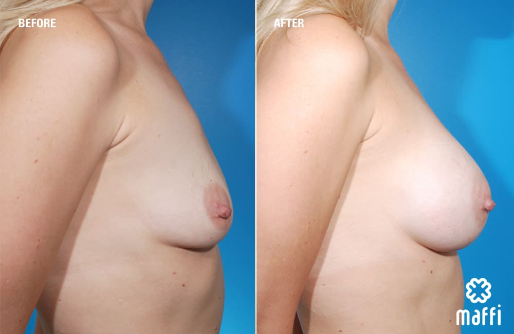 Before After Img