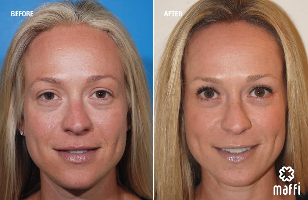 Before After Img