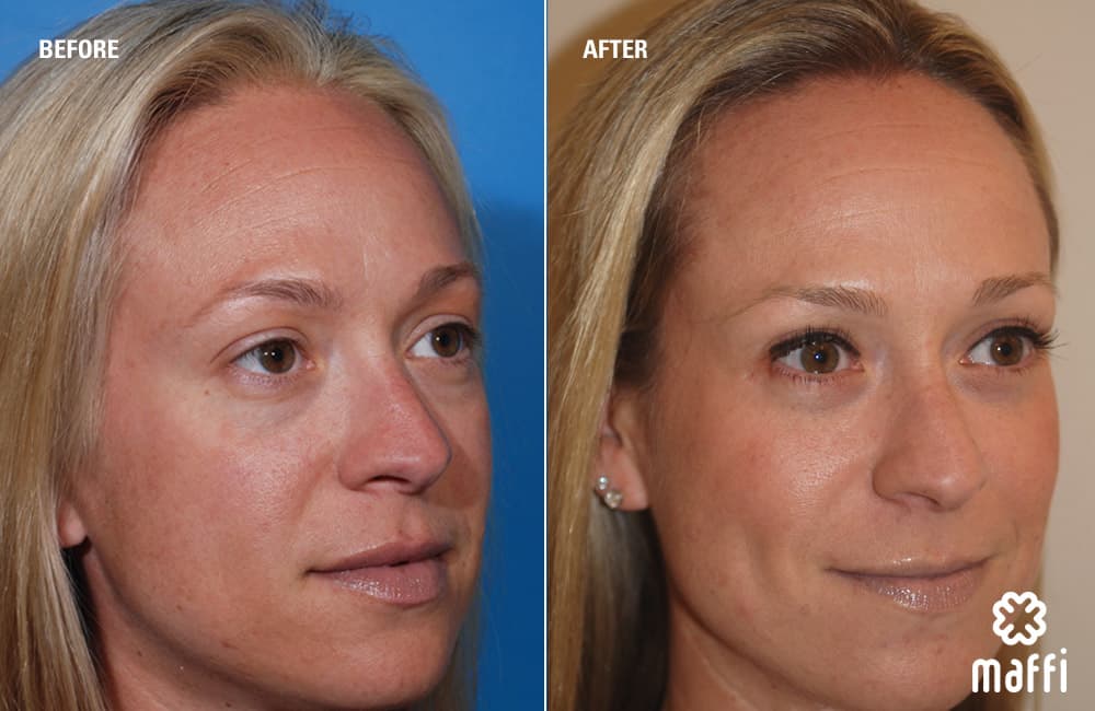 Before After Img