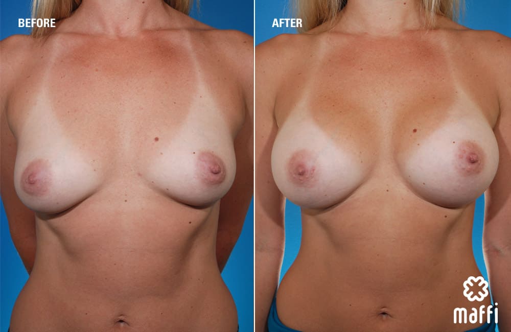Before After Img