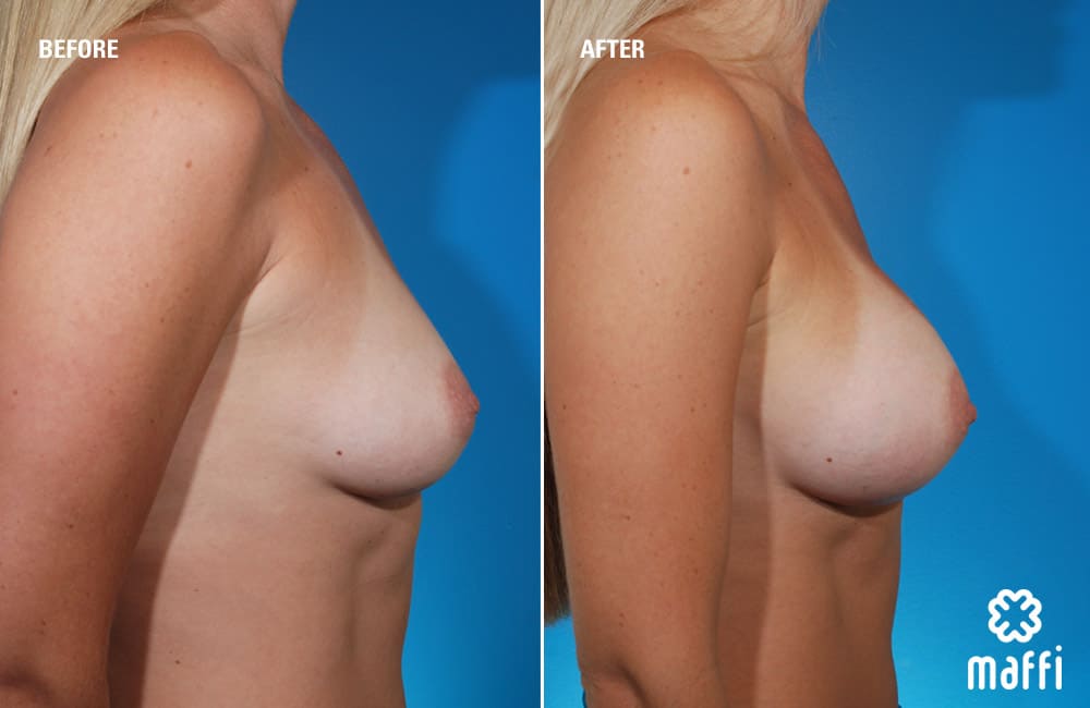 Before After Img
