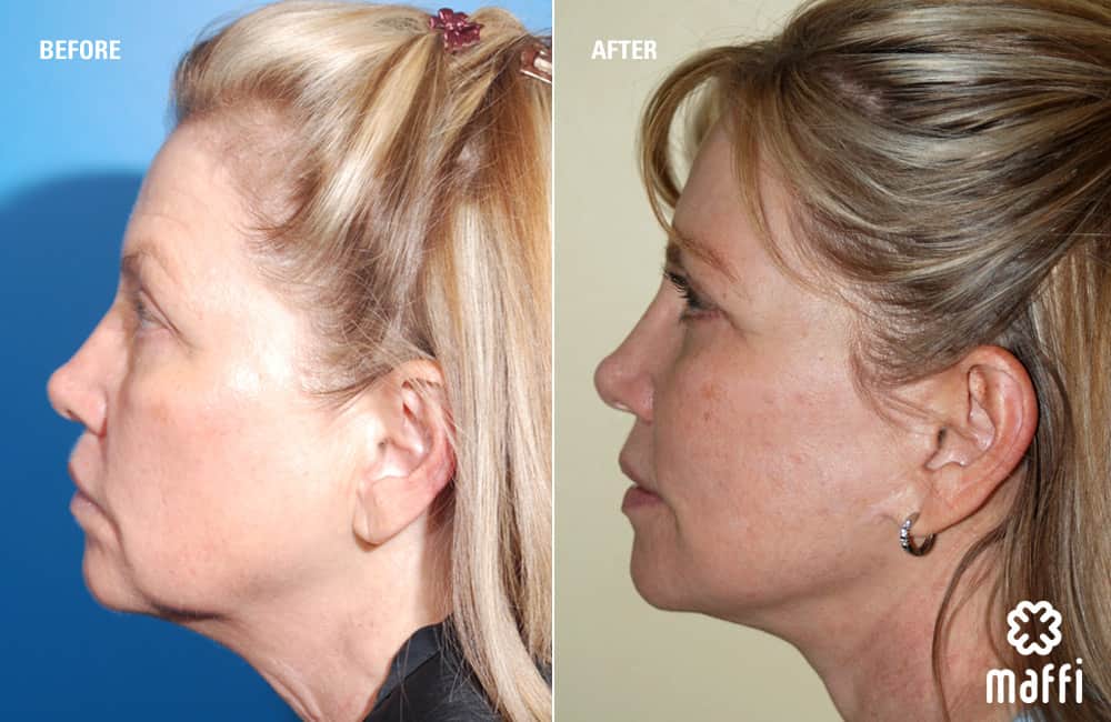 Before After Img