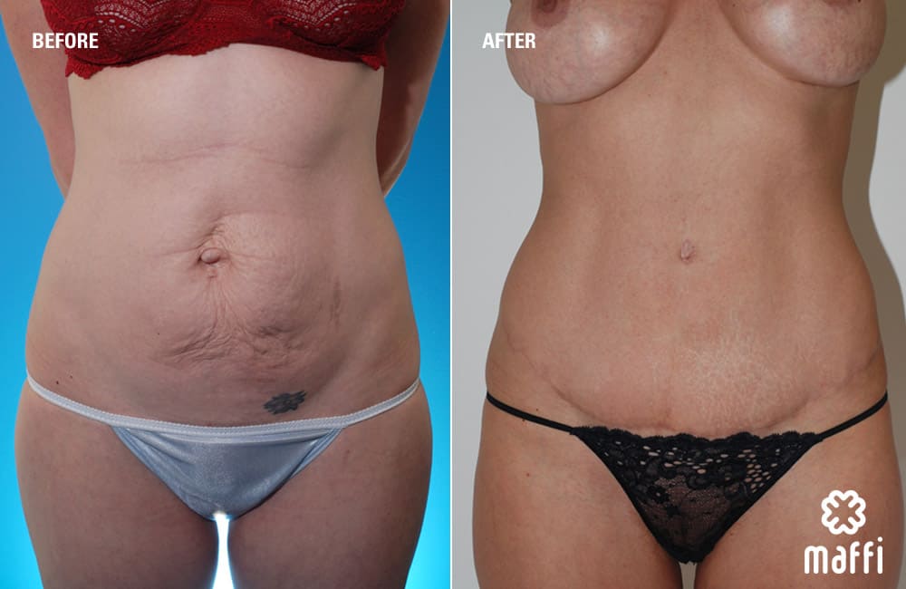 Before After Img