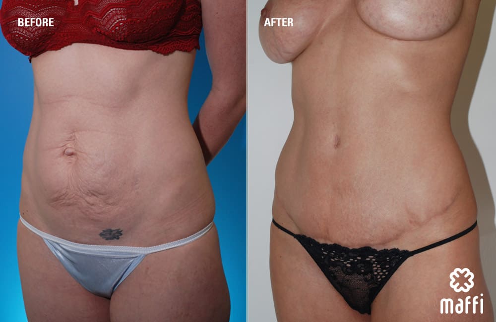 Before After Img