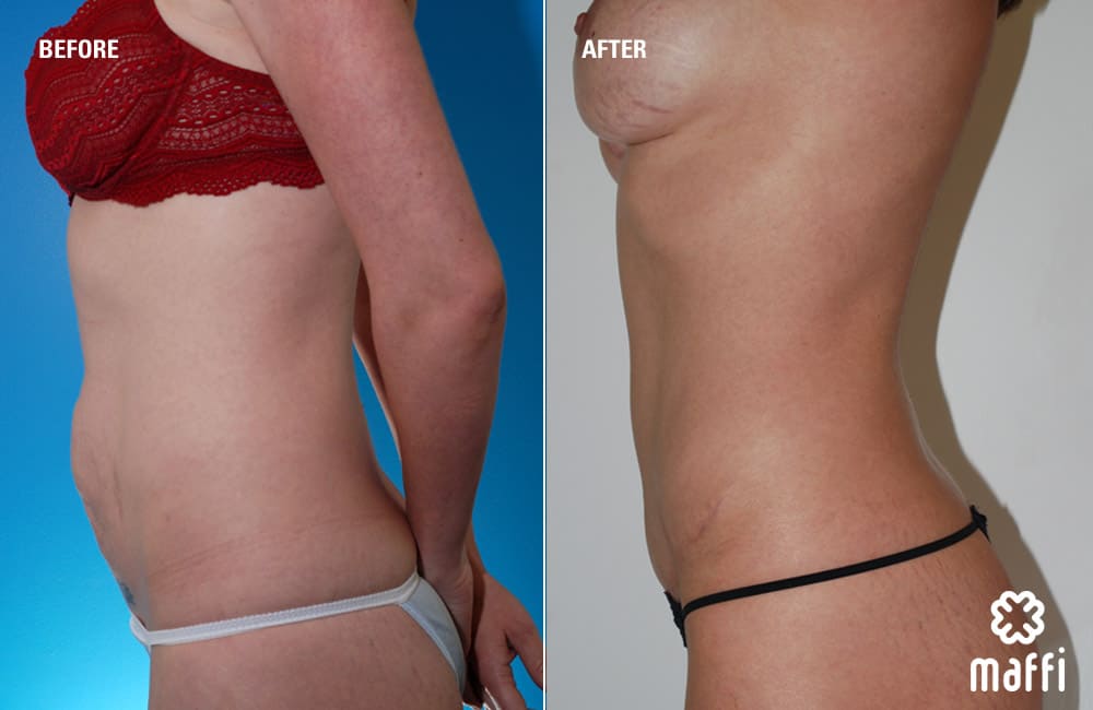 Before After Img