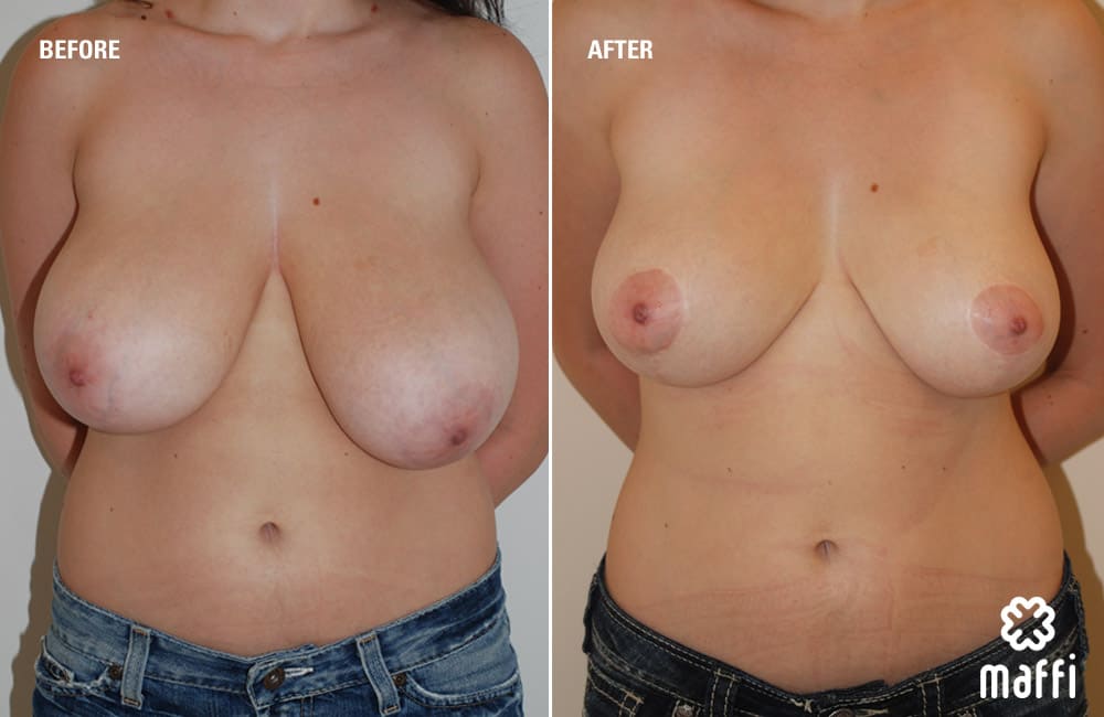 Before After Img