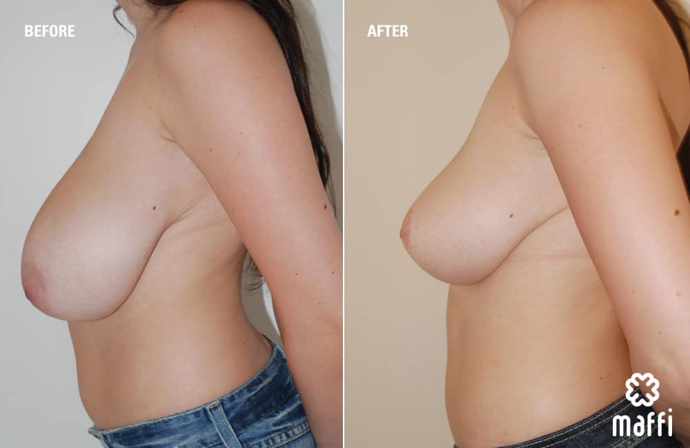 Before After Img