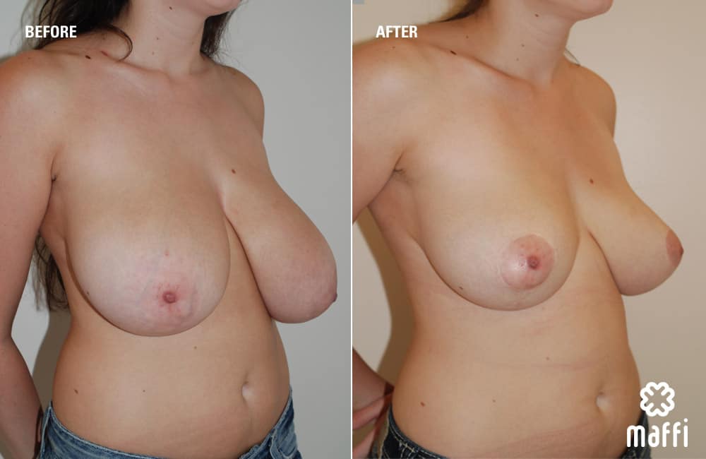 Before After Img