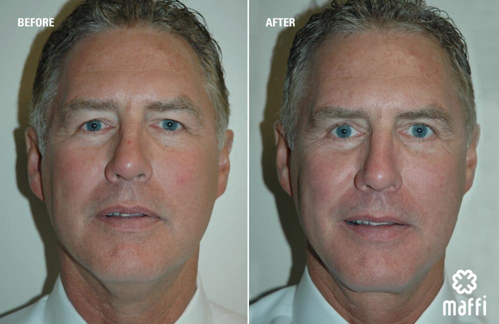 Before After Img