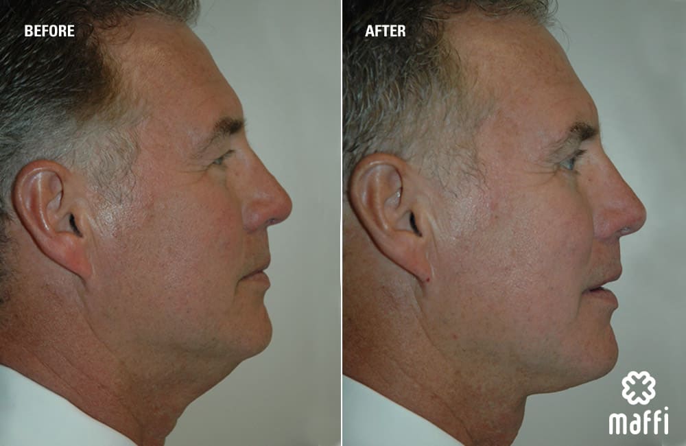 Before After Img