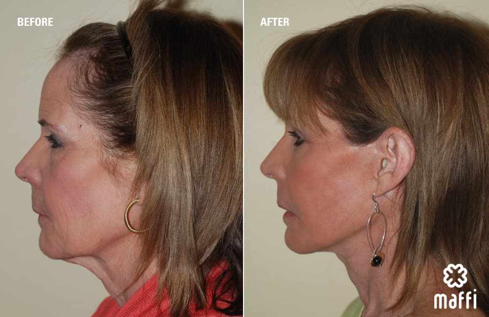 Before After Img