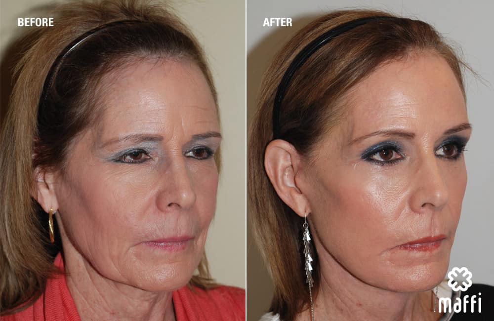 Before After Img