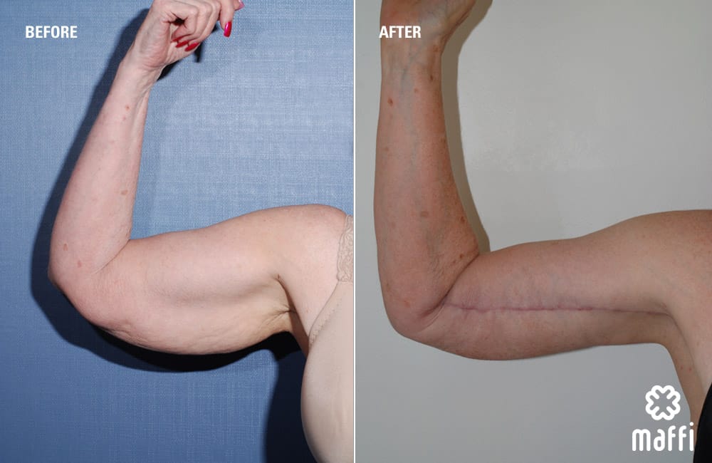 Before After Img