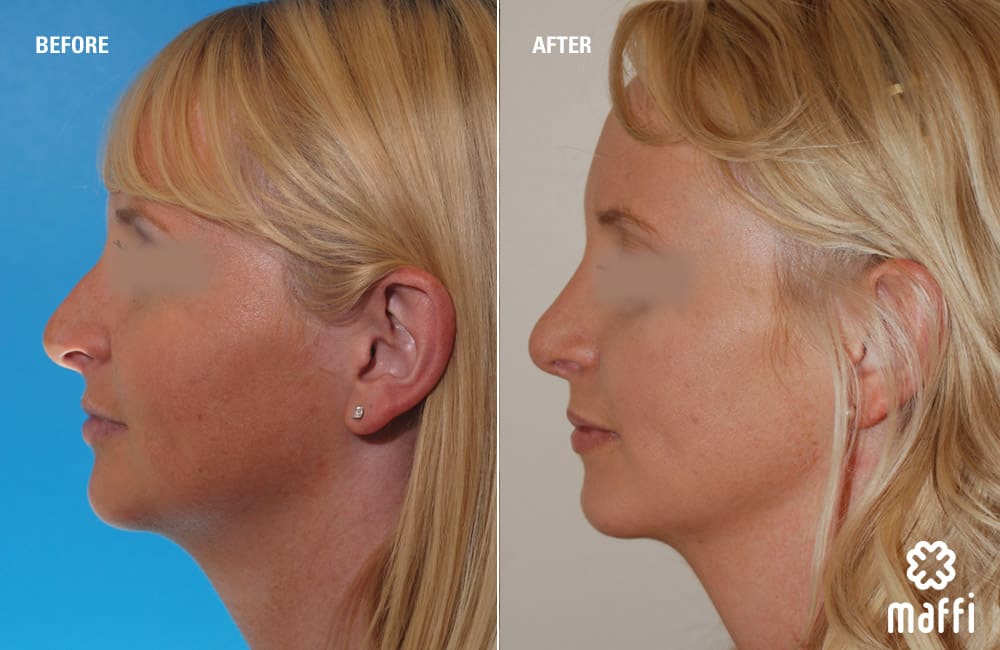 Before After Img
