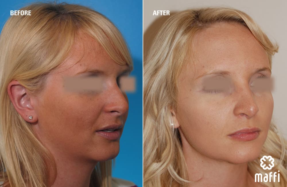 Before After Img