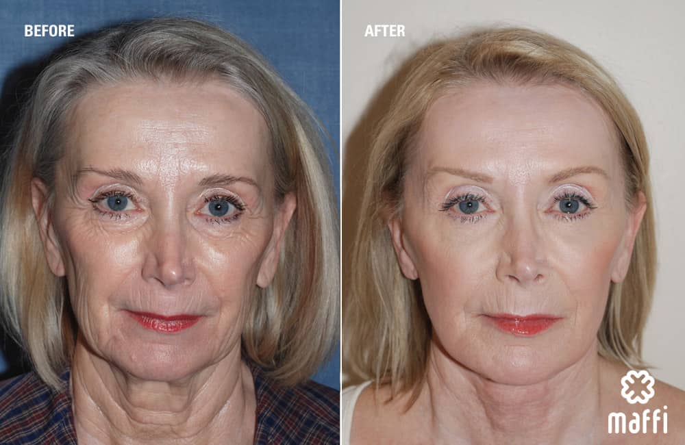 Before After Img