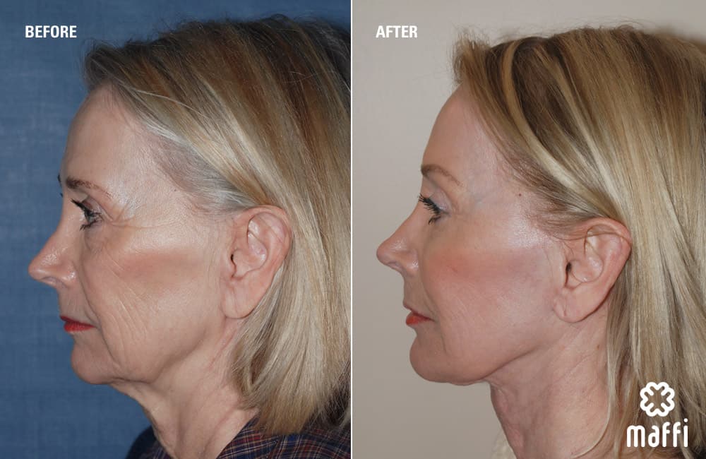 Before After Img
