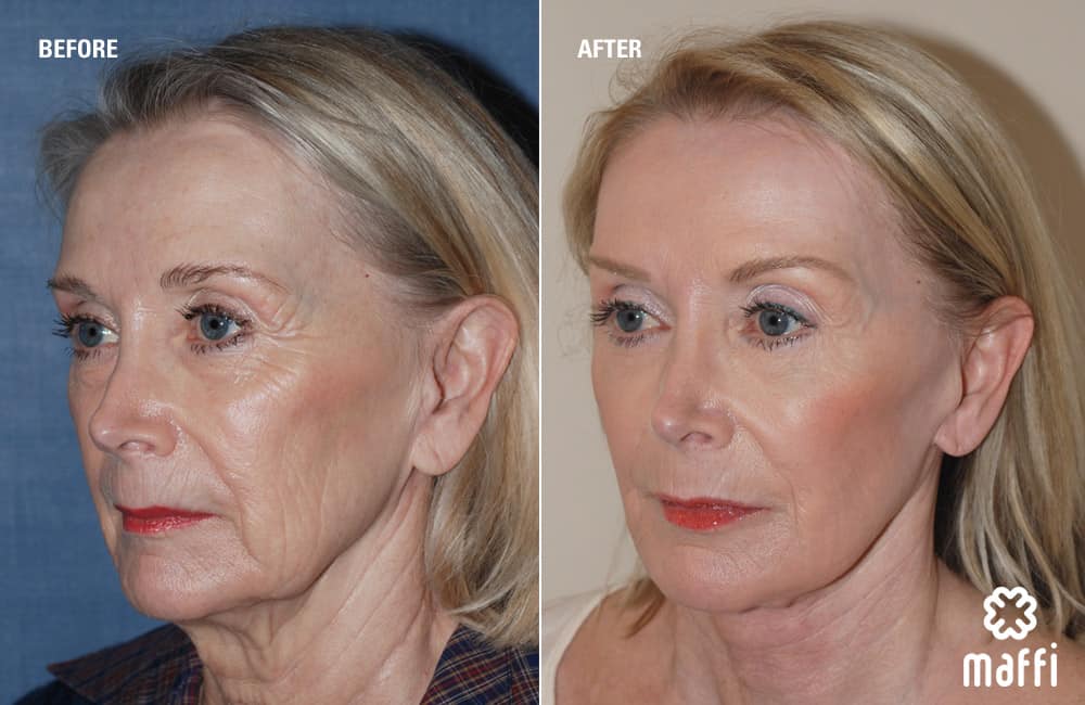 Before After Img