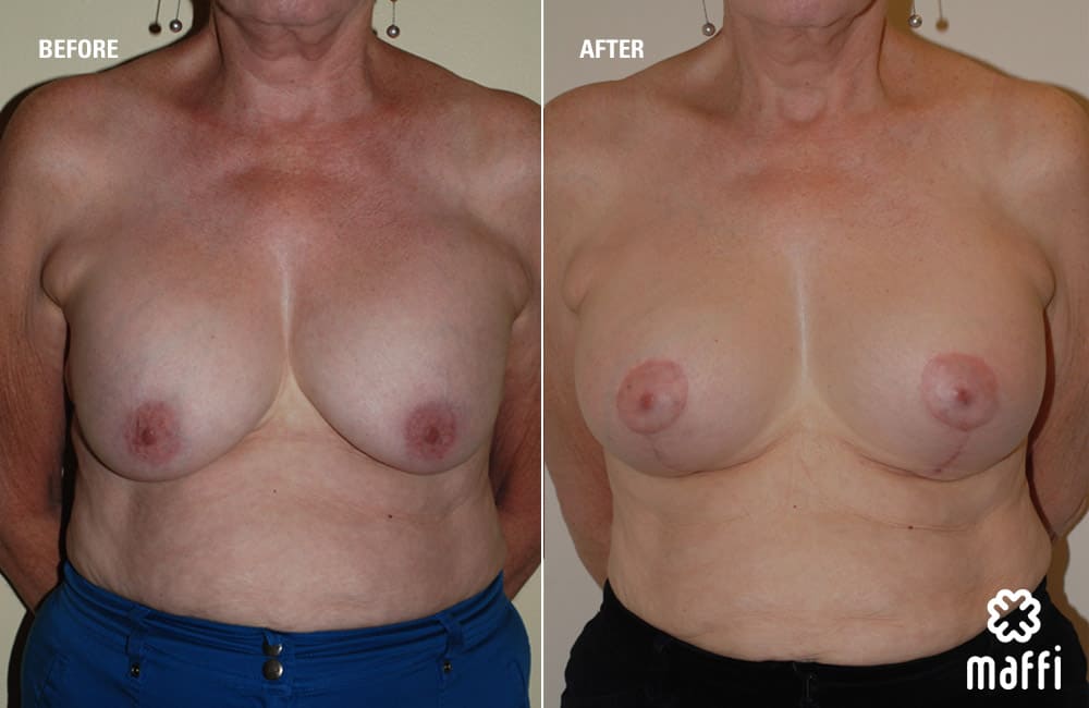 Before After Img