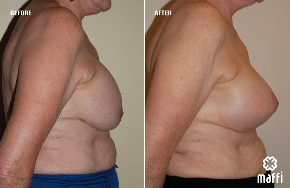 Before After Img