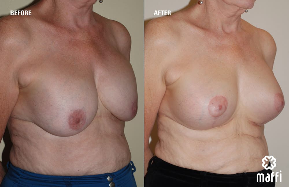 Before After Img