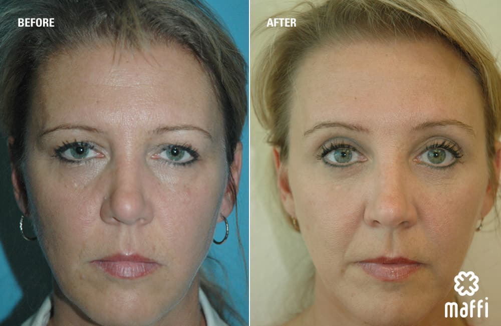 Before After Img