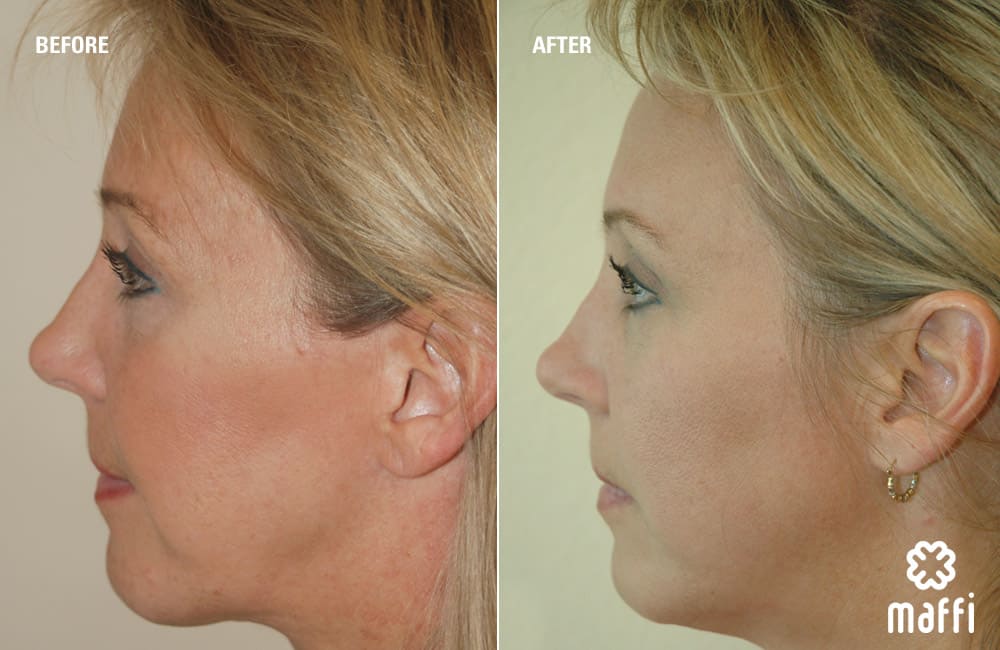 Before After Img