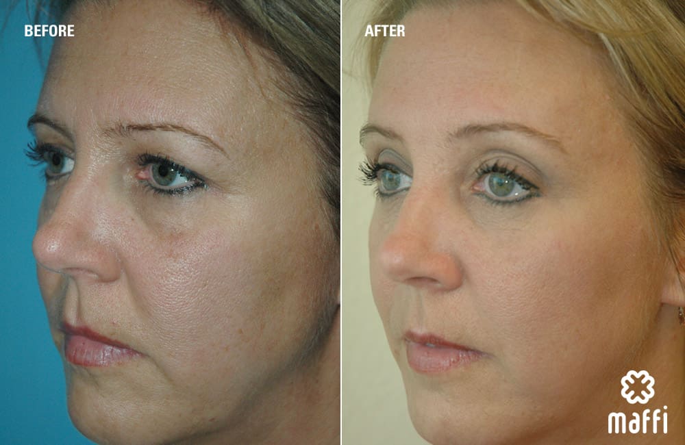 Before After Img