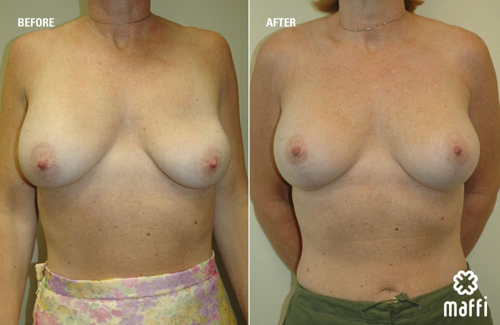 Before After Img