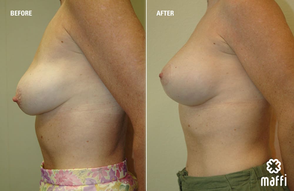 Before After Img