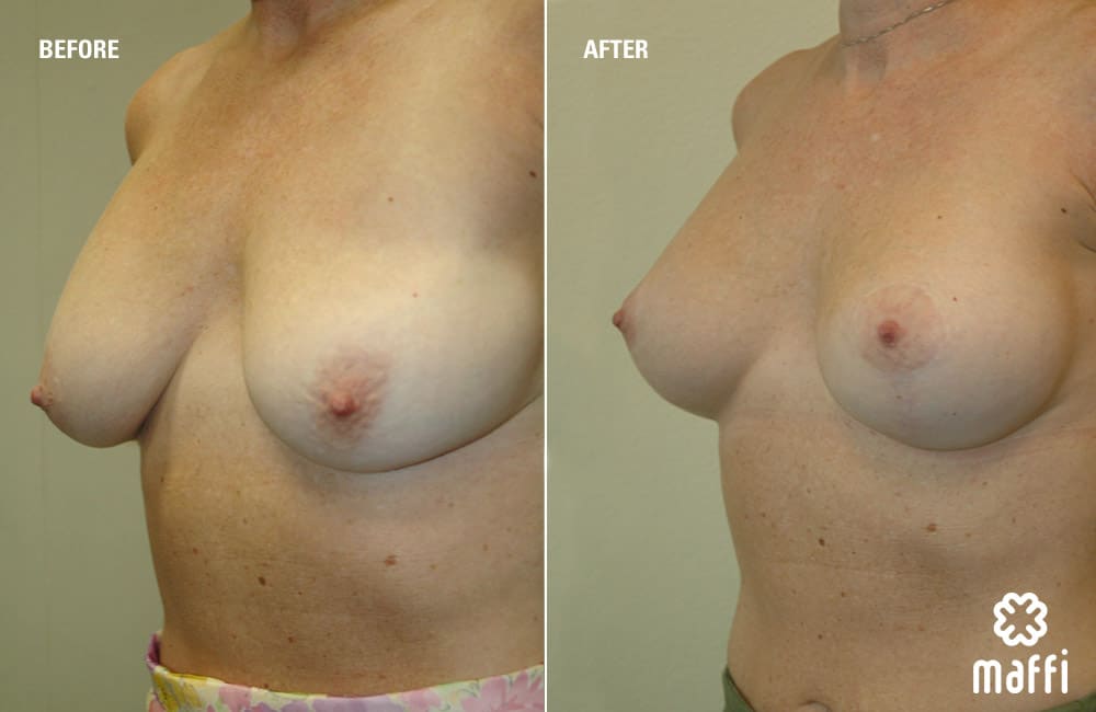 Before After Img